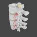 3d Протрузия и грыжа в поясничном отделе позвоночника модель купить - ракурс